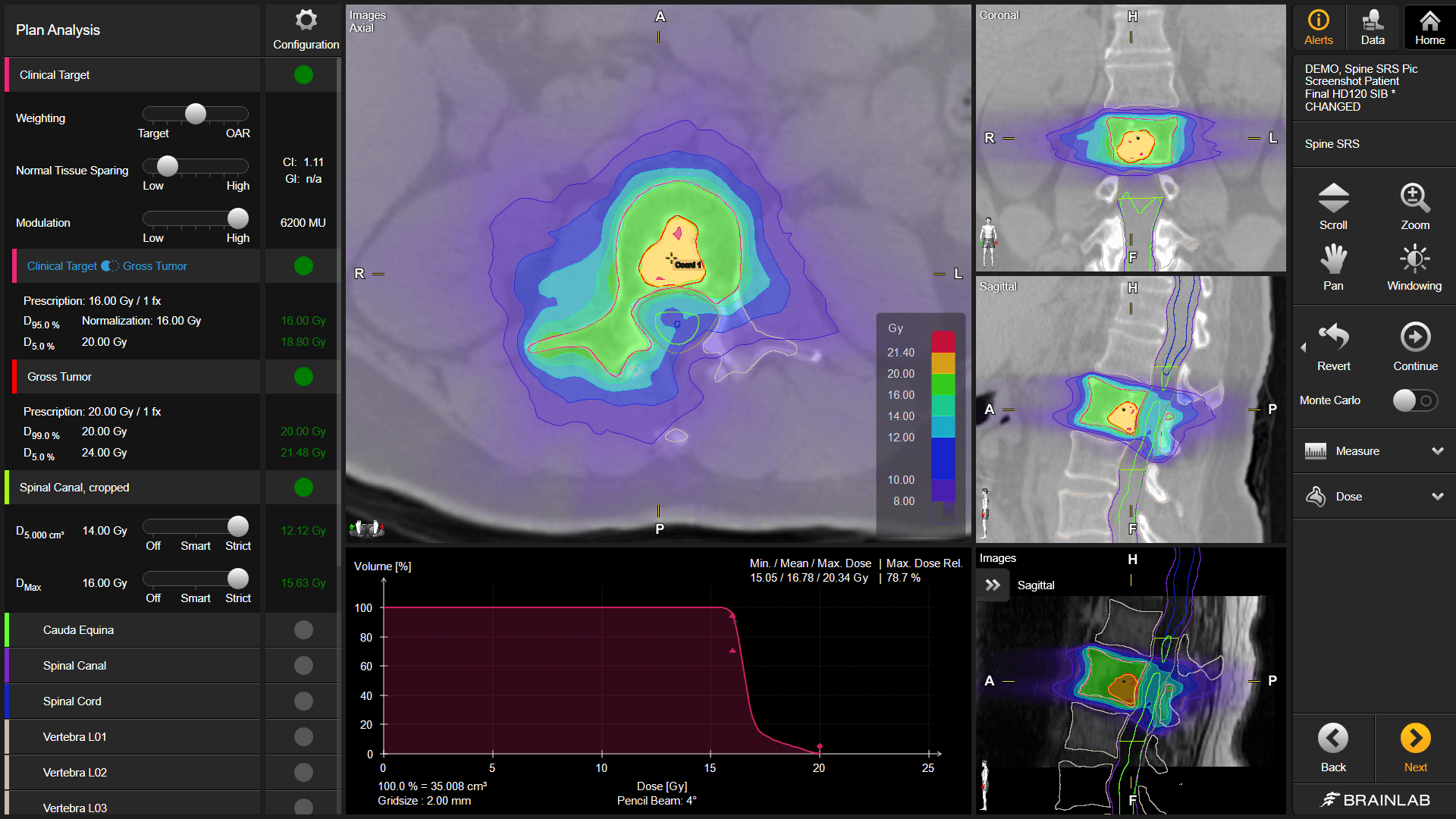 Elements Spine SRS: Spine Metastases Planning | Brainlab